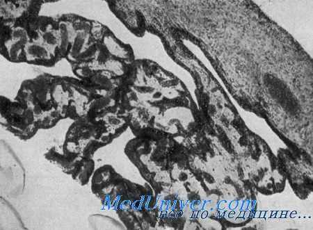 радужка при отравлении йодом