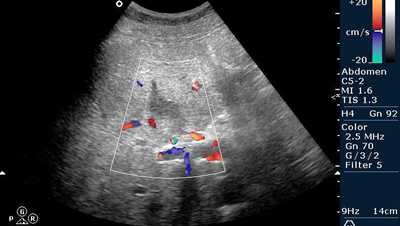 эхогенность печени