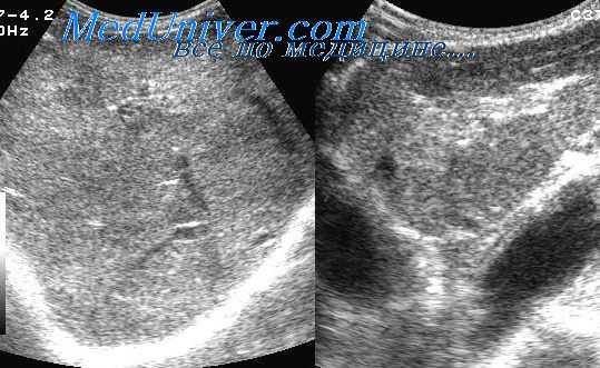 изменения печени на узи