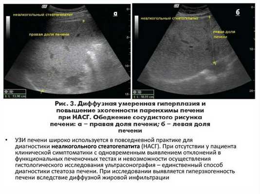 Повышенная эхогенность печени