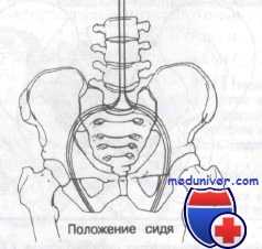 перелом костей таза
