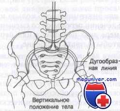 перелом костей таза