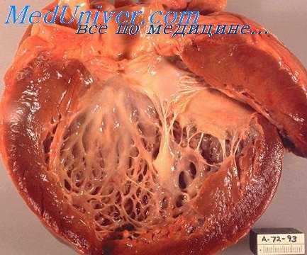 ревматический эндомиокардит