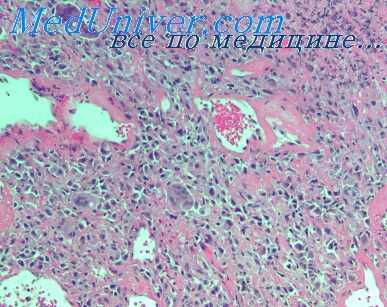 радиационная пневмония