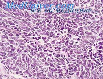 осложнения лучевой болезни