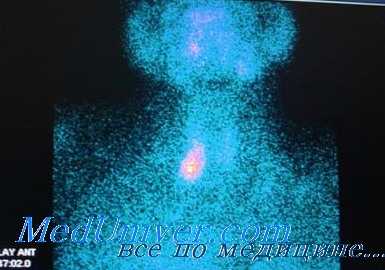 диффузный токсический зоб