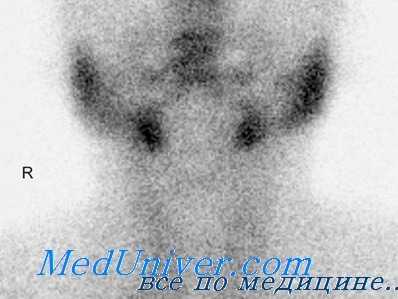радиоактивный йод