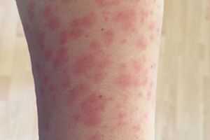 Токсикодермия