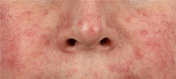 Демодекоз и розацеа.jpg