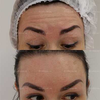 До и После - лоб и межбровье