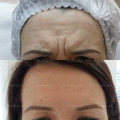 До и После - лоб и межбровье