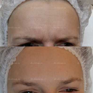 До и после. Мимические морщины 4