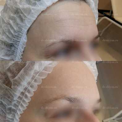 До и после. Мимические морщины 4