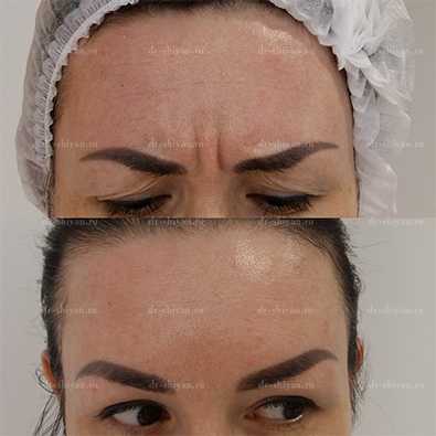 До и После - лоб и межбровье