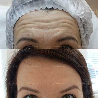 До и После - лоб и межбровье