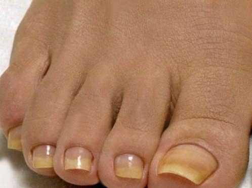 желтые ногти на ногах