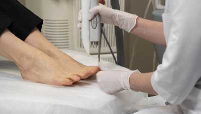 Лазерное удаление мозоли на пальце ноги