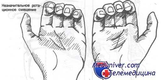 переломы фаланг пальцев кисти