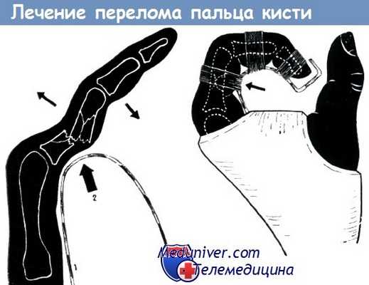 Лечение перелома пальца кисти