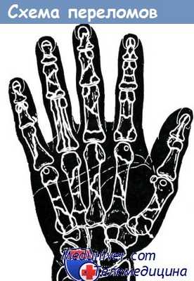 Схема переломов костей кисти