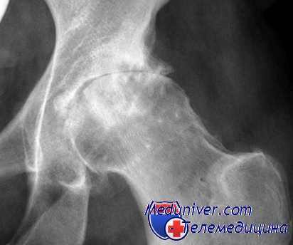 коксартроз