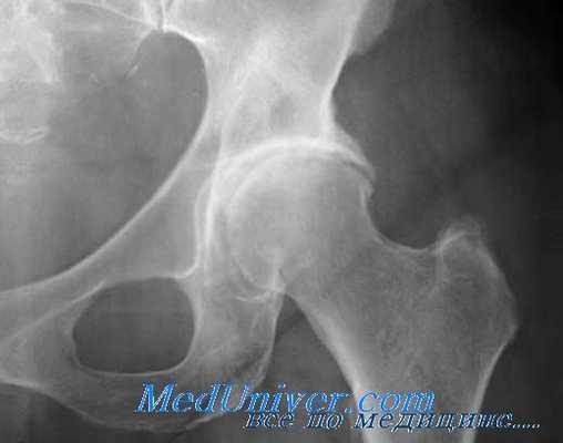 боль в тазобердренном суставе