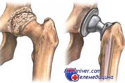 коксартроз