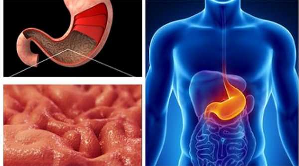 Гастрит с пониженной кислотностью