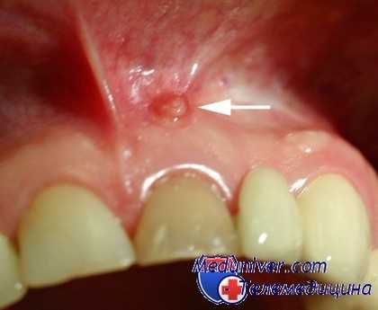 Свищ на десне из-за хронической инфекции в области корня зуба и его канала