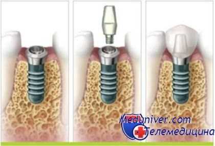 Этапы имплантации зуба и его осложнения