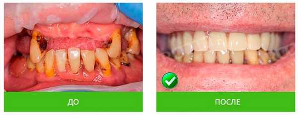 имплантация resmile в ROOTT