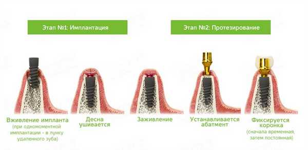 классическая имплантация в ROOTT