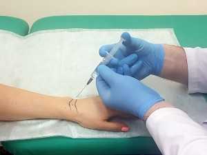 Блокада кисти - что это