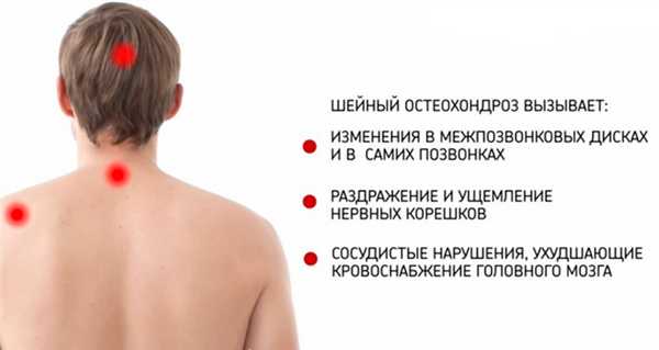 Последствия шейного остеохондроза