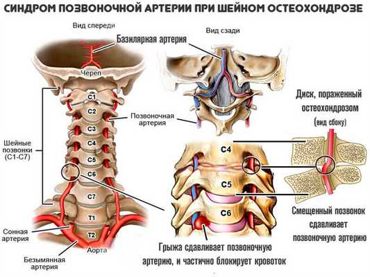 Синдром позвоночной артерии