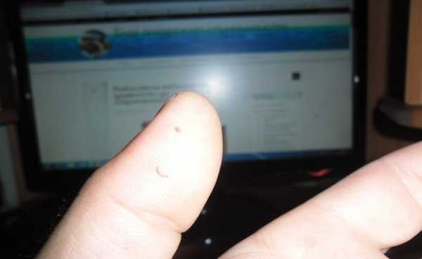 ранки на пальце от тройника