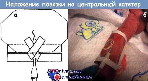 Наложение повязки на центральный катетер