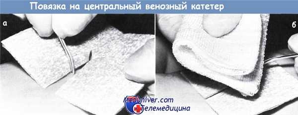 Повязка на центральный венозный катетер