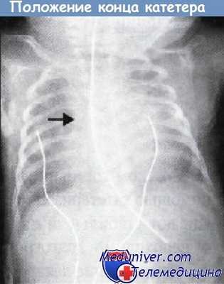Положение конца катетера