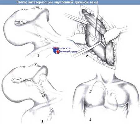 Этапы катетеризации внутренней яремной вены