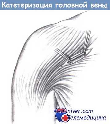 Катетеризация головной вены