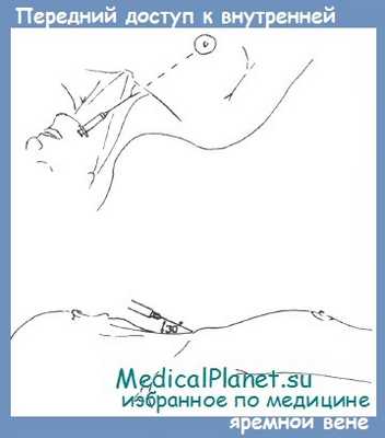 передний доступ к внутренней яремной вене