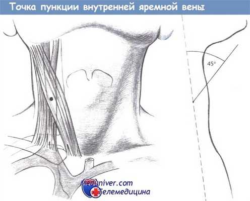 Точка пункции внутренней яремной вены