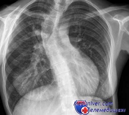 кифосколиоз