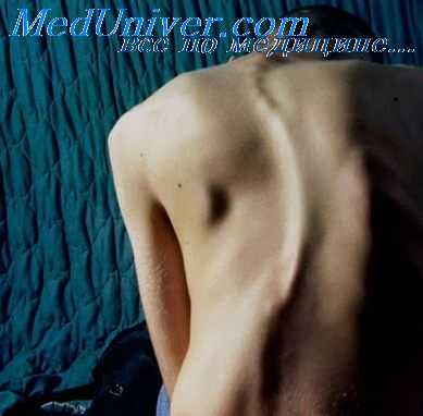 сколиоз у пациентов