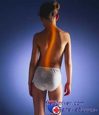 сколиоз у ребенка