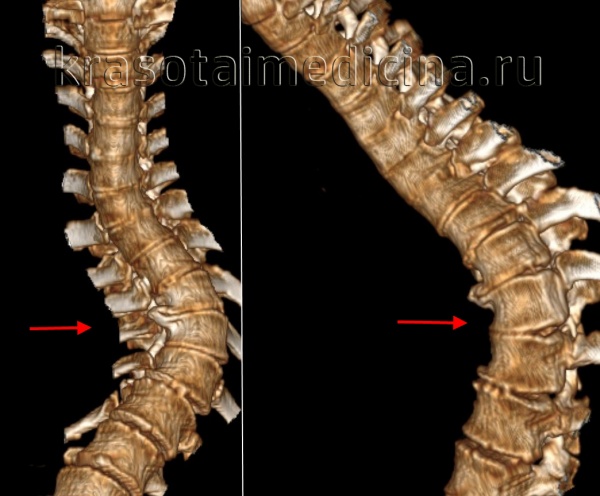 КТ ГОП (3D-реконструкции). Сколиотическая деформация (справа), кифотическая деформация (слева)