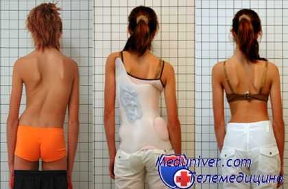 сколиоз у ребенка