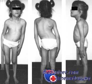 кифосколиоз