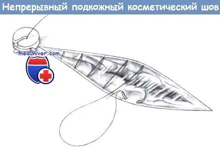 Непрерывный подкожный косметический шов